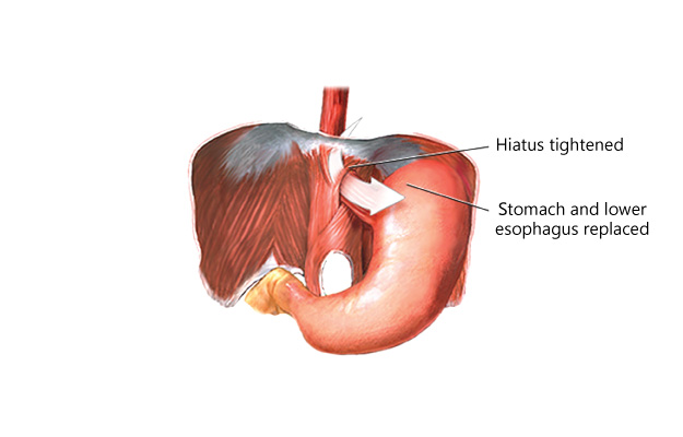 laparoscopic anti-reflux treatment in kolkata