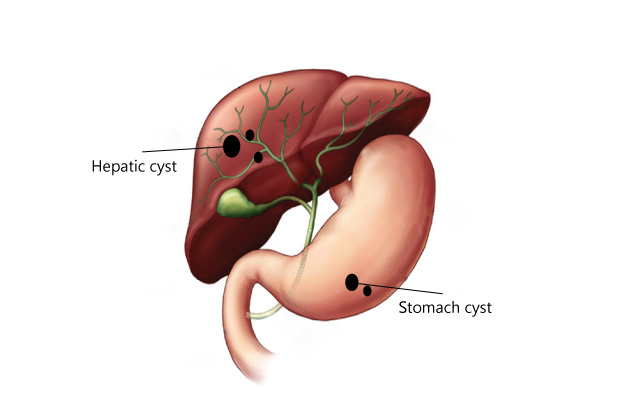 gastrointestinal cyst treatment