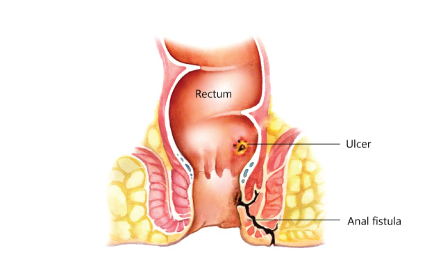 laser treatment for fistula in kolkata