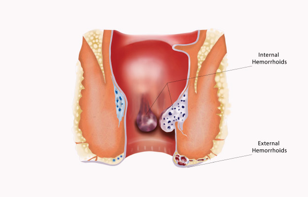 laser treatment for piles in kolkata