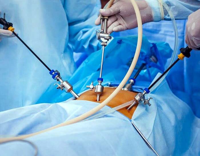 Laparoscopy procedure