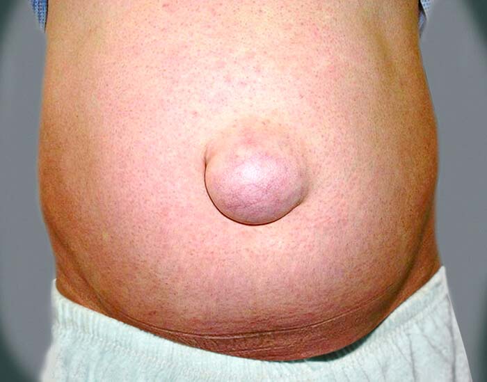 Hernia procedure