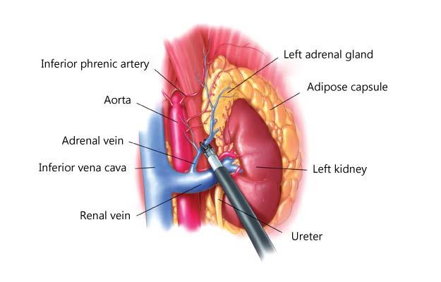 best adrenalectomy-surgeon in kolkata