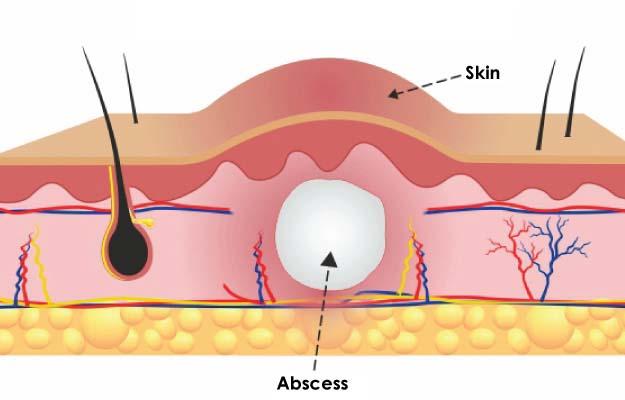 best-breast-abscess-removal-surgeon-in-kolkata