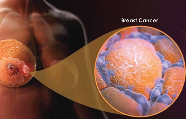 breast cancer treatment in kolkata