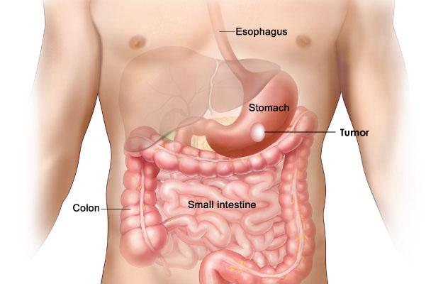 gastrointestinal stromal tumor treatment