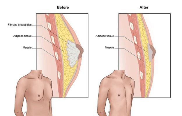 Can Gynecomastia Go Away with Exercise?