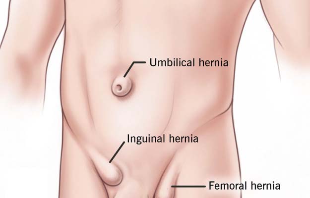 laparoscopic hernia treatment in kolkata