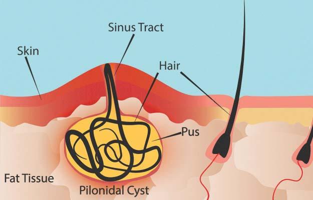 laser treatment for pilonidal sinus in kolkata