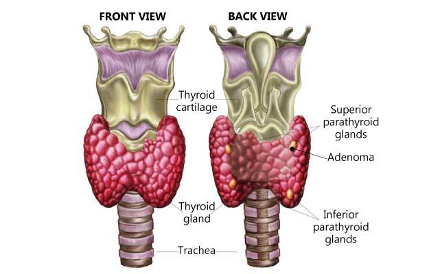 parathyroid adenoma