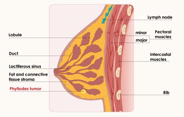 breast phyllodes tumor treatment in kolkata