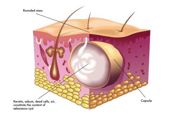 subcutaneous cyst