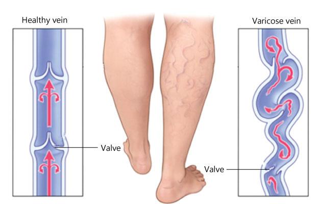 varicose veins treatment in kolkata