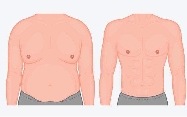 gynecomastia surgery in kolkata