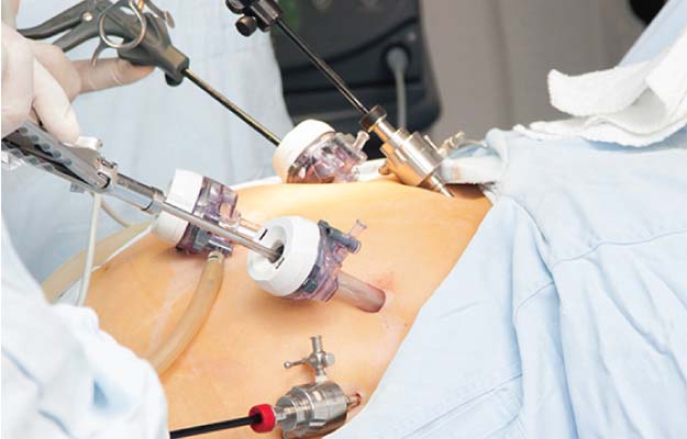 laparoscopic surgery in kolkata