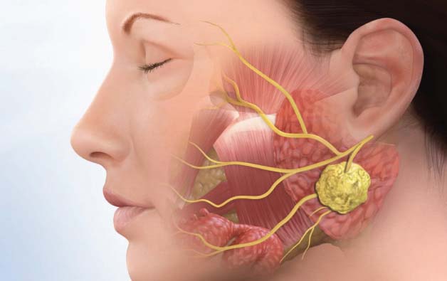 parotid gland surgery in kolkata