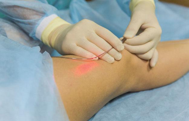 varicose veins surgery in kolkata